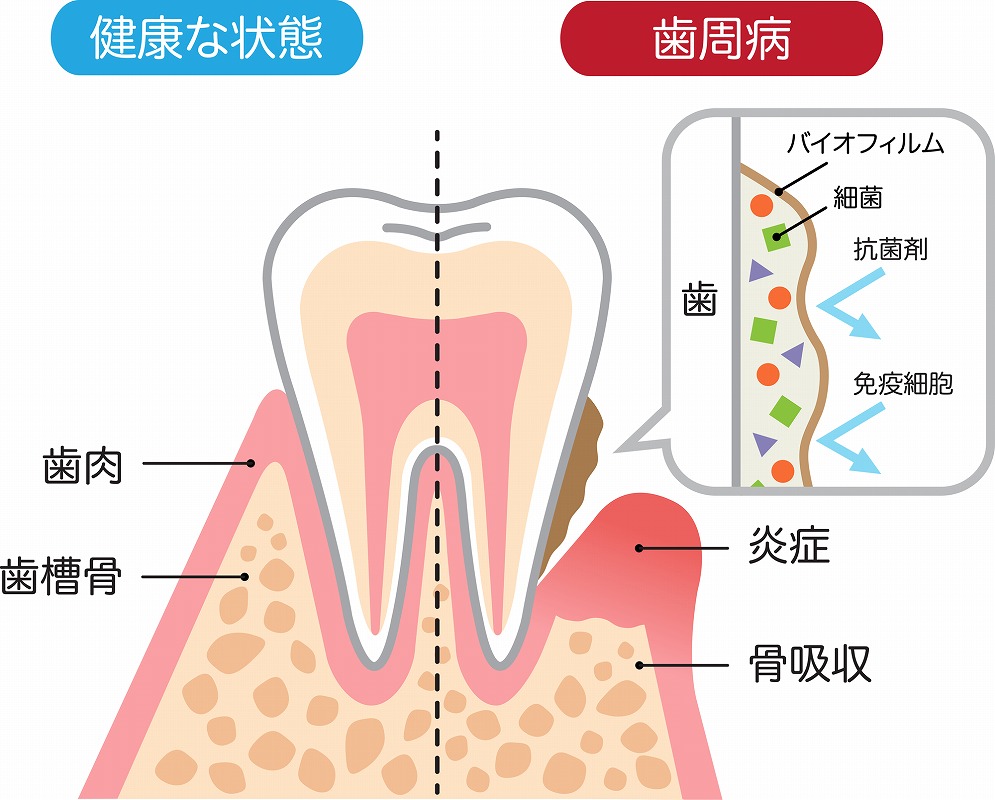 歯周病のセルフチェック