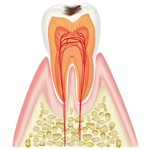 C1：エナメル質の虫歯